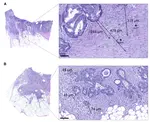 Distance-based evaluation of tumor budding in colorectal cancer