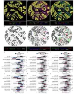 Impact of stromal maturity and proportion on prognosis and immune landscape in colorectal cancer